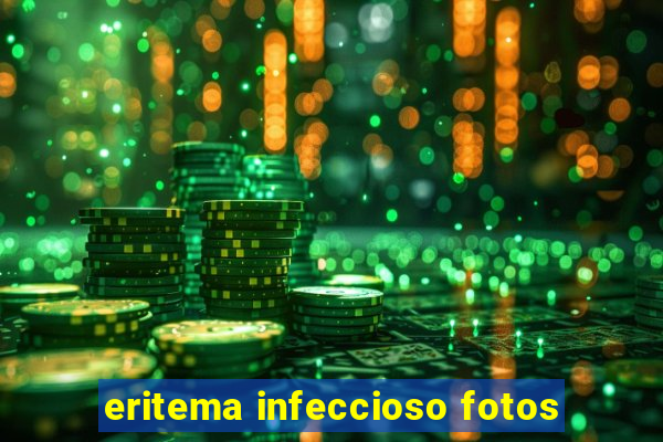 eritema infeccioso fotos